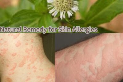 Natural Remedy for Skin Allergies: Mystery herb can Help Soothe Your Itchy Rashes (NH)