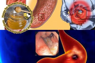 Honey for Stomach Ulcers: Benefits, Usage, and Important Considerations (NH)