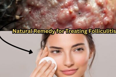 Natural Remedy for Treating Folliculitis- Ingrown Hair or Pores Infection (NH)