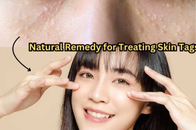 Natural Remedy for Treating Skin Tags: A Simple DIY Formula (NH)
