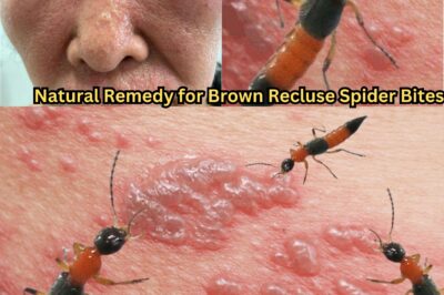 Natural Remedy for Brown Recluse Spider Bites: Soothe the Pain and Promote Healing (NH)