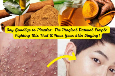 Say Goodbye to Pimples: The Magical Natural Pimple-Fighting Mix That’ll Have Your Skin Singing! (NH)