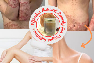 Effective Natural Remedy for Fungal Infections: A Simple and Powerful Recipe (NH)