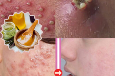 Say Goodbye to Pus-Filled Pimples: The Ultimate Natural Remedy for Body Acne (NH)