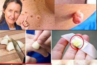 Plantar Warts and Skin Tags Disappear Naturally—Try This Overnight Remedy (an)