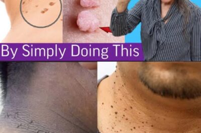Plantar Warts and Skin Tags Disappear Overnight with this recipe /d