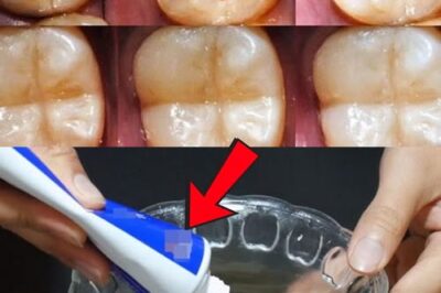How to Naturally Repair a Cavity & Strengthen Your Teeth /d