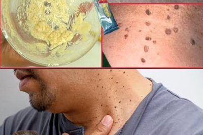 Plantar Warts and Skin Tags Disappear Naturally—Try This Overnight Remedy /d