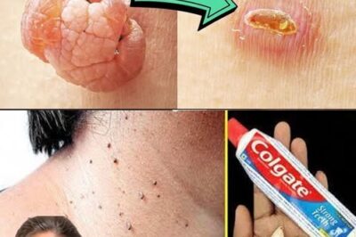 🌿 Say Goodbye to Warts & Skin Tags Naturally – A Simple Remedy That Works Overnight /d