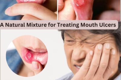 A Natural Mixture for Treating Mouth Ulcers: A Herbal Remedy (NH)