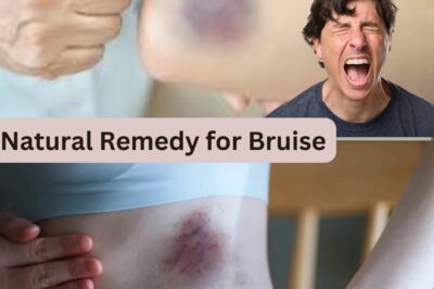 Say Goodbye to Bruises: Discover the Powerful Natural Herbal Mixture That Heals Faster and Relieves Pain Instantly! (NH)