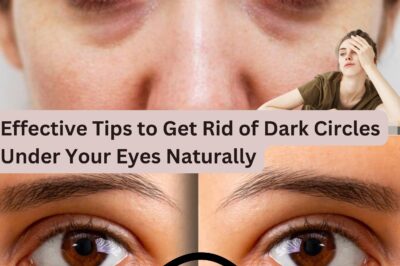 Tired of Looking Tired? Try These Effective Home Remedies to Banish Dark Circles and Rejuvenate Your Eyes! (NH)