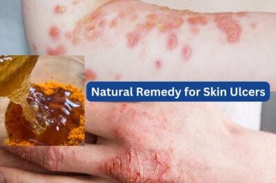 The Powerful Remedy That Could Speed Up Healing for Skin Ulcers (NH)
