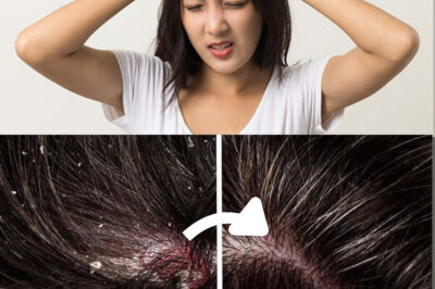 Natural Remedies for Dandruff: Effective Solutions for a Flake-Free Scalp (NH)