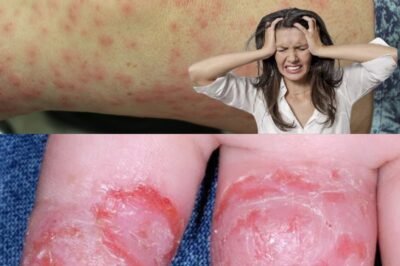 Natural Remedies for Treating Dermatitis with Common Ingredients (NH)
