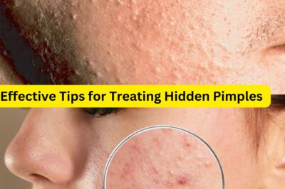 Effective Tips for Treating Hidden Pimples That You Don’t Know!!! (NH)